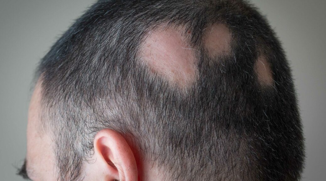 Age-Related Hair Loss Solutions: Minoxidil's Role in Effective Treatment