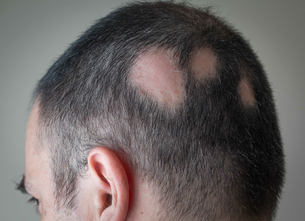 Age-Related Hair Loss Solutions: Minoxidil's Role in Effective Treatment